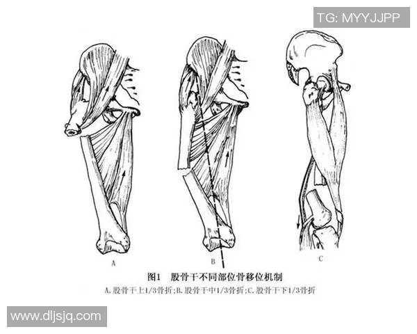 足球股骨髁损伤的预防与治疗方法探讨及康复训练建议